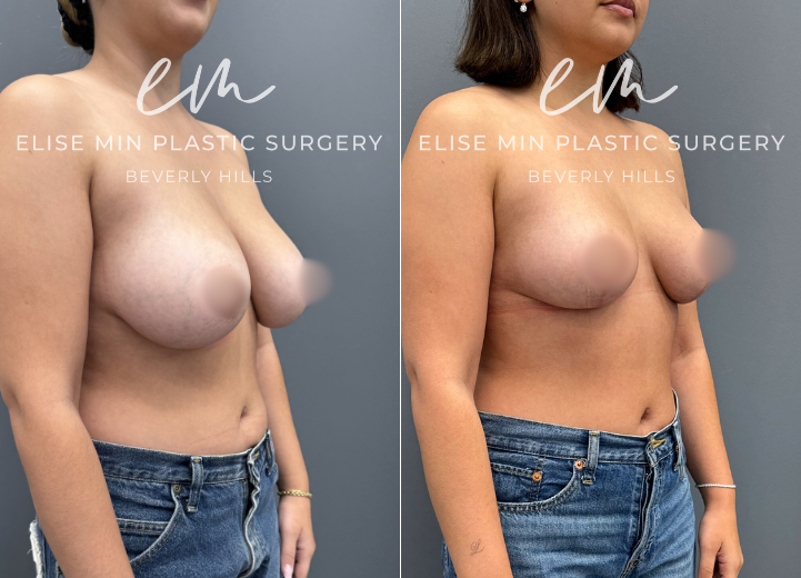This 28-year-old woman presented with D to DD cup breasts and longstanding symptoms of heaviness and bra strap grooving that interfered with her daily activities. Although others reassured her that her breasts were not “too large,” she consistently felt uncomfortable and weighed down. She underwent a vertical scar breast reduction with 200g removed from each breast and elected placement of Galatea® synthetic absorbable mesh for added long-term soft tissue support. She is now a lifted C cup and reports a remarkable sense of lightness and relief.