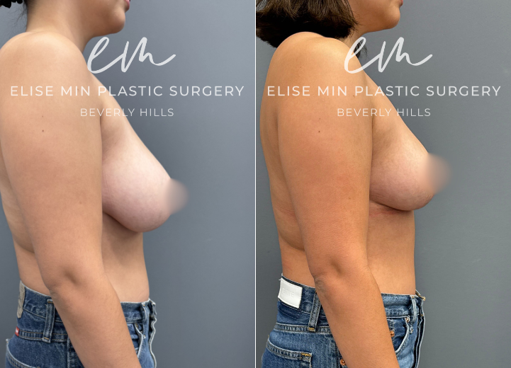 This 28-year-old woman presented with D to DD cup breasts and longstanding symptoms of heaviness and bra strap grooving that interfered with her daily activities. Although others reassured her that her breasts were not “too large,” she consistently felt uncomfortable and weighed down. She underwent a vertical scar breast reduction with 200g removed from each breast and elected placement of Galatea® synthetic absorbable mesh for added long-term soft tissue support. She is now a lifted C cup and reports a remarkable sense of lightness and relief.