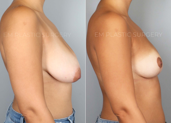 This is a petite 33-year-old woman who had been considering a breast reduction procedure for many years. She felt that her breast size did not match her petite frame and experienced the weight of her droopy breasts affecting her posture over the years. She underwent a vertical breast reduction with the minimal scar approach ('lollipop'-scar) and had 173g removed from the left breast and 139g removed from the right breast. She went from 30DDD cup-sized breasts to her desired C cup-size after the procedure. She was excited to share that her posture improved, and feeling a lot lighter in the chest, she's enjoying not wearing a bra at all.