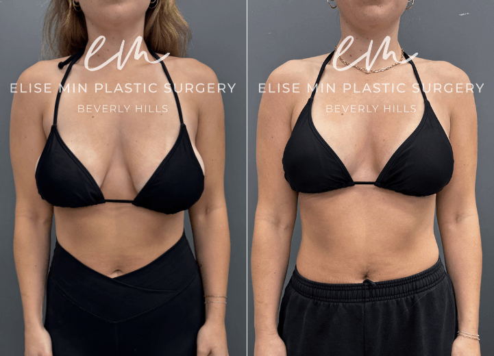 This is a 25-year-old patient with a history of 32F breasts and noticeable asymmetry who underwent a modified vertical L-scar breast reduction to achieve a more balanced, proportionate figure. She now feels lighter and much more comfortable in her clothing, with improved symmetry and overall contour.