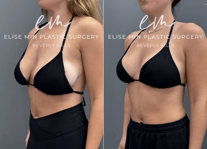 This is a 25-year-old patient with a history of 32F breasts and noticeable asymmetry who underwent a modified vertical L-scar breast reduction to achieve a more balanced, proportionate figure. She now feels lighter and much more comfortable in her clothing, with improved symmetry and overall contour.