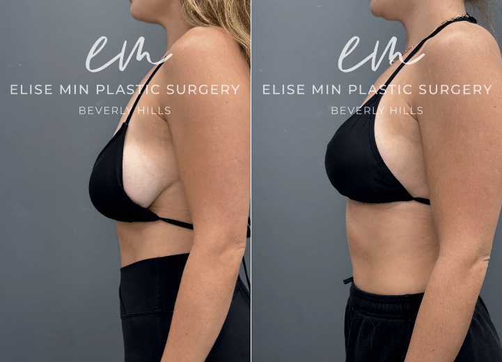 This is a 25-year-old patient with a history of 32F breasts and noticeable asymmetry who underwent a modified vertical L-scar breast reduction to achieve a more balanced, proportionate figure. She now feels lighter and much more comfortable in her clothing, with improved symmetry and overall contour.