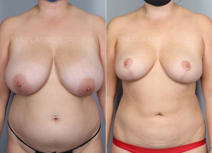 This is a 30-year-old woman who had been considering a breast reduction procedure
since she was a teenager. She had been seeing a chiropractor for over a decade but
her neck and back pain never improved. She underwent a vertical breast reduction with
the minimal scar approach (&#39;lollipop&#39;-scar) and had 420g removed from the left breast
and 370g removed from the right breast. She wasn’t sure what her cup size was prior to
surgery but postoperatively, she was fitting into a C cup-size. Her neck and back pain
also fully went away after the surgery.