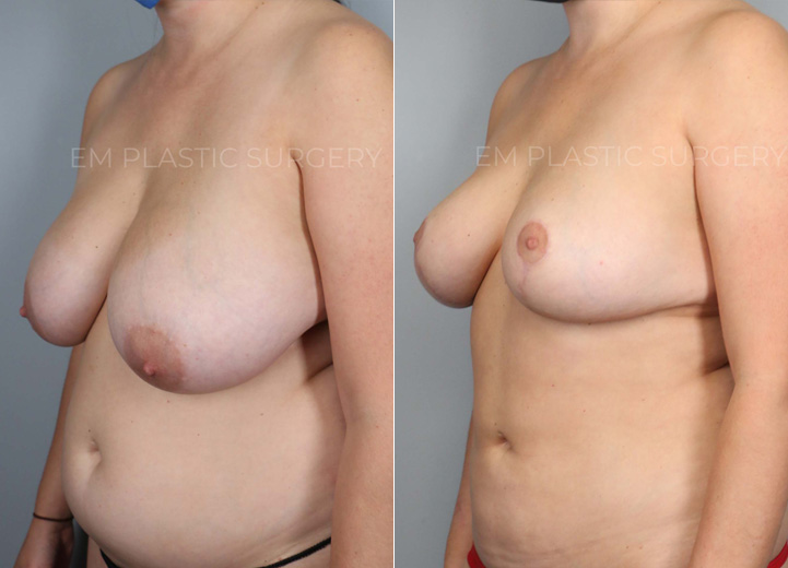 This is a 30-year-old woman who had been considering a breast reduction procedure
since she was a teenager. She had been seeing a chiropractor for over a decade but
her neck and back pain never improved. She underwent a vertical breast reduction with
the minimal scar approach (&#39;lollipop&#39;-scar) and had 420g removed from the left breast
and 370g removed from the right breast. She wasn’t sure what her cup size was prior to
surgery but postoperatively, she was fitting into a C cup-size. Her neck and back pain
also fully went away after the surgery.