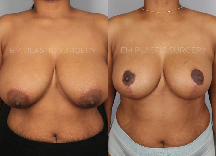This is a 37-year-old woman who had been considering a breast reduction procedure
due to her severe upper back pain and frequent skin irritation along her breast fold. She
underwent a vertical breast reduction with the minimal scar approach (&#39;lollipop&#39;-scar)
and had 400g removed from the left breast and 380g removed from the right breast.
She wanted a fuller, feminine look and was fitting into a D cup-size postoperatively.