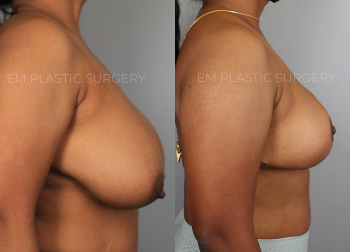 This is a 37-year-old woman who had been considering a breast reduction procedure
due to her severe upper back pain and frequent skin irritation along her breast fold. She
underwent a vertical breast reduction with the minimal scar approach (&#39;lollipop&#39;-scar)
and had 400g removed from the left breast and 380g removed from the right breast.
She wanted a fuller, feminine look and was fitting into a D cup-size postoperatively.