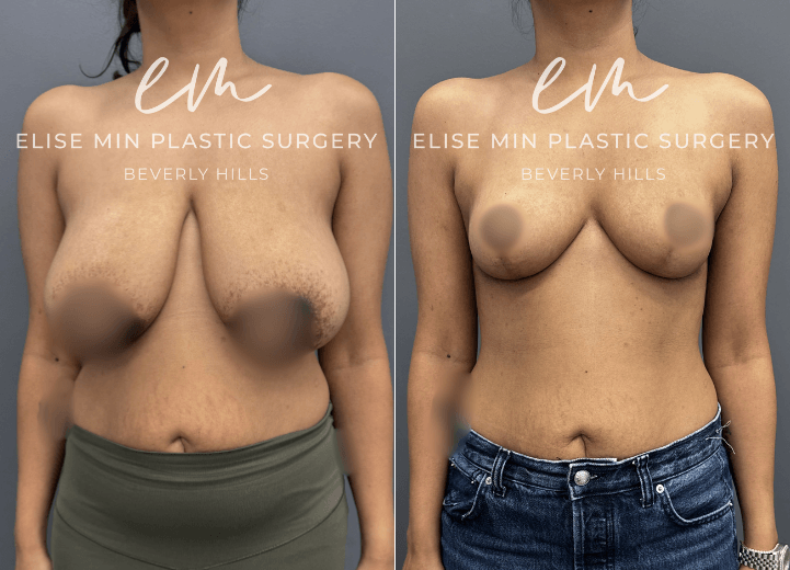 This is a 30-year-old patient who had been a 32G for most of her life and felt deeply self-conscious, often dressing to minimize her chest rather than express herself. After having a baby and deciding she was done having children, she felt ready to reclaim her body and confidence. She underwent a modified vertical L-scar breast reduction (530g  and 510g removed from each breast) to achieve a more balanced, proportionate figure. Now, she feels lighter, more comfortable in her clothes, and moves through life with a renewed sense of confidence and ease.