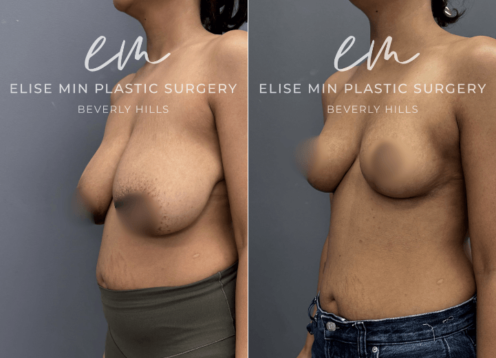 This is a 30-year-old patient who had been a 32G for most of her life and felt deeply self-conscious, often dressing to minimize her chest rather than express herself. After having a baby and deciding she was done having children, she felt ready to reclaim her body and confidence. She underwent a modified vertical L-scar breast reduction (530g  and 510g removed from each breast) to achieve a more balanced, proportionate figure. Now, she feels lighter, more comfortable in her clothes, and moves through life with a renewed sense of confidence and ease.