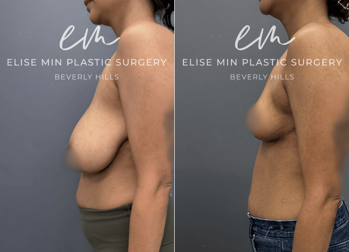 This is a 30-year-old patient who had been a 32G for most of her life and felt deeply self-conscious, often dressing to minimize her chest rather than express herself. After having a baby and deciding she was done having children, she felt ready to reclaim her body and confidence. She underwent a modified vertical L-scar breast reduction (530g  and 510g removed from each breast) to achieve a more balanced, proportionate figure. Now, she feels lighter, more comfortable in her clothes, and moves through life with a renewed sense of confidence and ease.