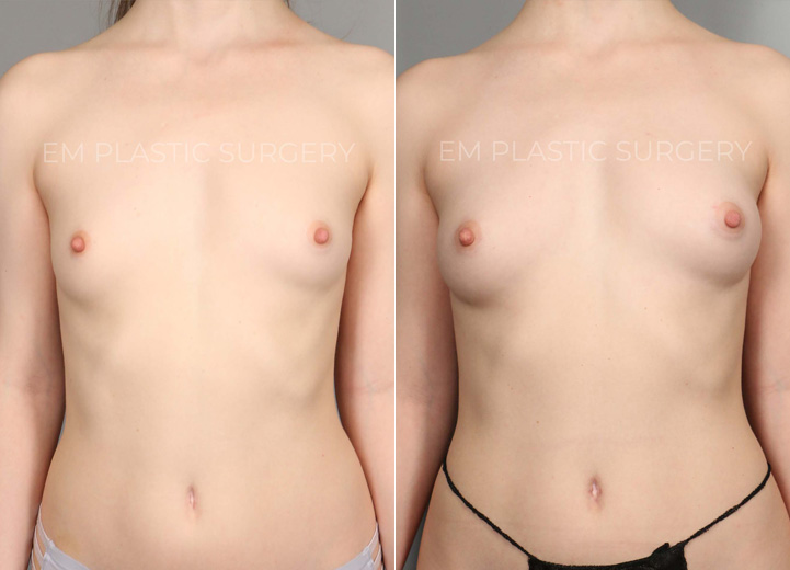 This is a 30 year-old woman who had small B cup-sized breasts. She was mostly content with
her breast shape and size but wanted her breasts to fill in her bra a little more. She was hoping
for a fuller B cup size. The only issue was she was overall very thin, but that meant I had to go to
multiple sites to harvest enough fat to graft. After finding fat cells from her abdomen, flanks,
lower back and thighs, I transferred 120cc fat cells to the right breast and 100cc to the left
breast. This is her postoperative result after six months from the time of her procedure, and
she is looking fabulous and feeling great about how her breasts fit in her bra.