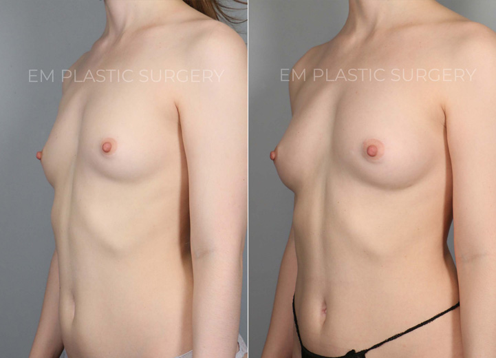 This is a 30 year-old woman who had small B cup-sized breasts. She was mostly content with
her breast shape and size but wanted her breasts to fill in her bra a little more. She was hoping
for a fuller B cup size. The only issue was she was overall very thin, but that meant I had to go to
multiple sites to harvest enough fat to graft. After finding fat cells from her abdomen, flanks,
lower back and thighs, I transferred 120cc fat cells to the right breast and 100cc to the left
breast. This is her postoperative result after six months from the time of her procedure, and
she is looking fabulous and feeling great about how her breasts fit in her bra.
