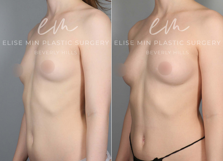 This is a 30 year-old woman who had small B cup-sized breasts. She was mostly content with her breast shape and size but wanted her breasts to fill in her bra a little more. She was hoping for a fuller B cup size. The only issue was she was overall very thin, but that meant I had to go to multiple sites to harvest enough fat to graft. After finding fat cells from her abdomen, flanks, lower back and thighs, I transferred 120cc fat cells to the right breast and 100cc to the left breast. This is her postoperative result after six months from the time of her procedure, and she is looking fabulous and feeling great about how her breasts fit in her bra.