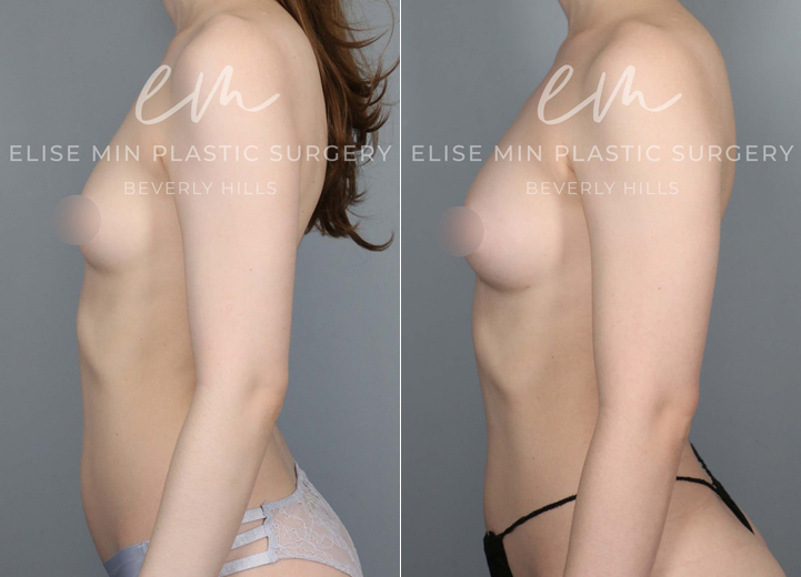This is a 30 year-old woman who had small B cup-sized breasts. She was mostly content with her breast shape and size but wanted her breasts to fill in her bra a little more. She was hoping for a fuller B cup size. The only issue was she was overall very thin, but that meant I had to go to multiple sites to harvest enough fat to graft. After finding fat cells from her abdomen, flanks, lower back and thighs, I transferred 120cc fat cells to the right breast and 100cc to the left breast. This is her postoperative result after six months from the time of her procedure, and she is looking fabulous and feeling great about how her breasts fit in her bra.
