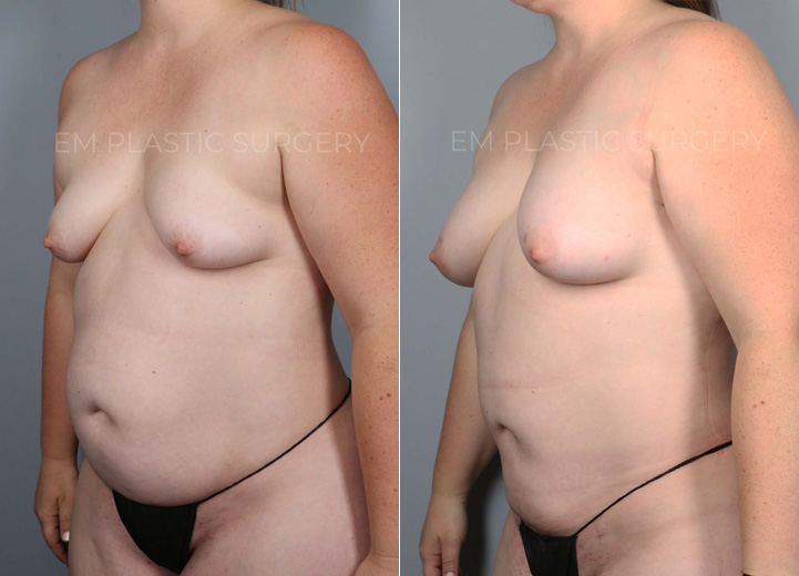 This is a 35 year-old woman who wanted a natural boost to her breasts without using any
implants. On exam, she had a mild degree of tuberous breasts that resulted in a cone-shaped
breast in the lower pole and less volume in the bottom half of her breast tissue. During the
operation, she had 240cc of fat cells injected into her right breast and 270cc of fat cells into her
left breast. She also underwent liposuction of the axillary fat to restore a more natural breast
shape. At her six-month postoperative visit, she was happy to show off her improved cleavage
and the fuller lower pole of her breasts. The extra volume has also led to a natural lifting effect
of her nipple areolas without a separate lift procedure.