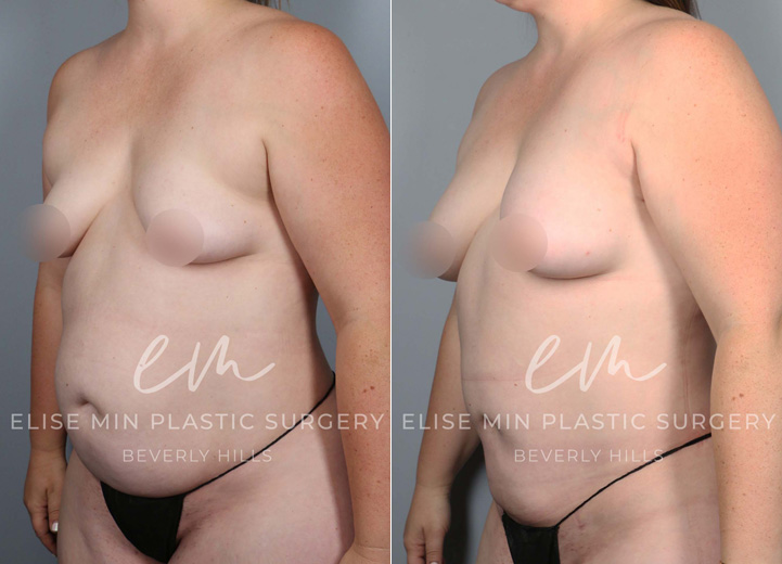 This is a 35 year-old woman who wanted a natural boost to her breasts without using any implants. On exam, she had a mild degree of tuberous breasts that resulted in a cone-shaped breast in the lower pole and less volume in the bottom half of her breast tissue. During the operation, she had 240cc of fat cells injected into her right breast and 270cc of fat cells into her left breast. She also underwent liposuction of the axillary fat to restore a more natural breast shape. At her six-month postoperative visit, she was happy to show off her improved cleavage and the fuller lower pole of her breasts. The extra volume has also led to a natural lifting effect of her nipple areolas without a separate lift procedure.