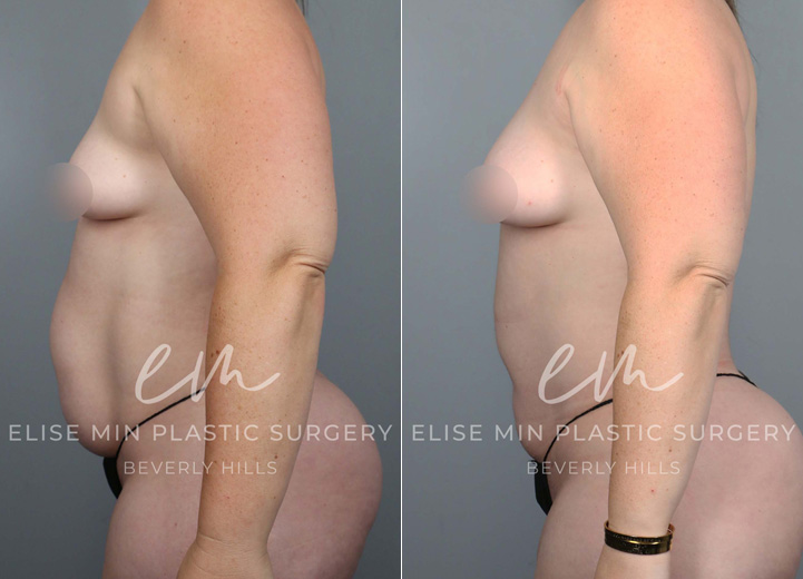 This is a 35 year-old woman who wanted a natural boost to her breasts without using any implants. On exam, she had a mild degree of tuberous breasts that resulted in a cone-shaped breast in the lower pole and less volume in the bottom half of her breast tissue. During the operation, she had 240cc of fat cells injected into her right breast and 270cc of fat cells into her left breast. She also underwent liposuction of the axillary fat to restore a more natural breast shape. At her six-month postoperative visit, she was happy to show off her improved cleavage and the fuller lower pole of her breasts. The extra volume has also led to a natural lifting effect of her nipple areolas without a separate lift procedure.