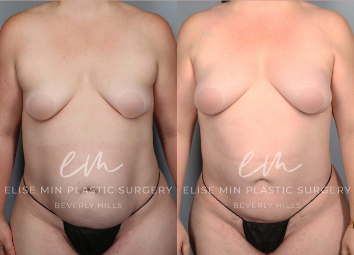 This is a 35 year-old woman who wanted a natural boost to her breasts without using any implants. On exam, she had a mild degree of tuberous breasts that resulted in a cone-shaped breast in the lower pole and less volume in the bottom half of her breast tissue. During the operation, she had 240cc of fat cells injected into her right breast and 270cc of fat cells into her left breast. She also underwent liposuction of the axillary fat to restore a more natural breast shape. At her six-month postoperative visit, she was happy to show off her improved cleavage and the fuller lower pole of her breasts. The extra volume has also led to a natural lifting effect of her nipple areolas without a separate lift procedure.