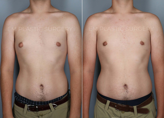 Gynecomastia Reduction Surgery Before & After