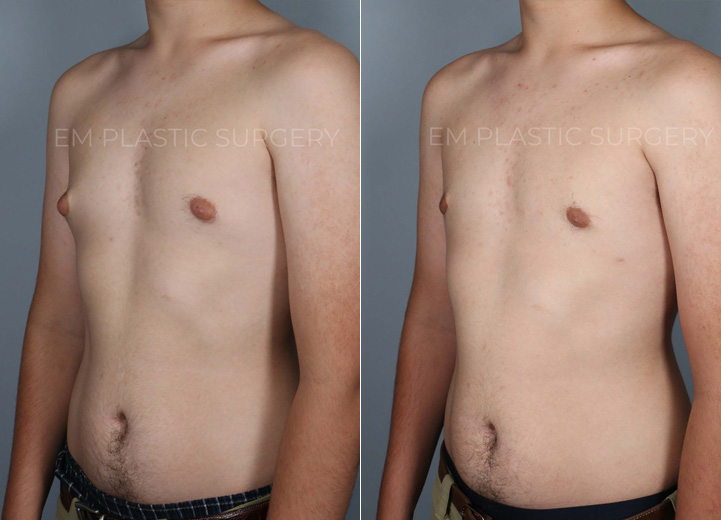 This is a 17-year-old teenage boy with gynecomastia who had been fully evaluated by his pediatric endocrinology doctor. After the workup revealed no underlying medical issues, the patient was referred for a surgical evaluation to address his protruding nipple areolar complex, with the right side being worse than the left. He felt self-conscious that the nipple area would poke through any t-shirt. He wanted to get this addressed before heading off to college and got his wish by undergoing an excision of the firm breast tissue through a short curved scar around the nipple areolar complex. Additionally, he had gentle liposuction of the adipose tissue on both sides of the chest.