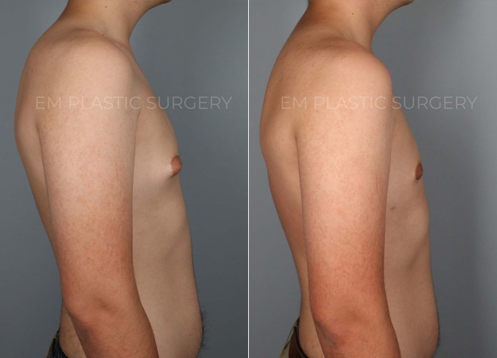 This is a 17-year-old teenage boy with gynecomastia who had been fully evaluated by his pediatric endocrinology doctor. After the workup revealed no underlying medical issues, the patient was referred for a surgical evaluation to address his protruding nipple areolar complex, with the right side being worse than the left. He felt self-conscious that the nipple area would poke through any t-shirt. He wanted to get this addressed before heading off to college and got his wish by undergoing an excision of the firm breast tissue through a short curved scar around the nipple areolar complex. Additionally, he had gentle liposuction of the adipose tissue on both sides of the chest.