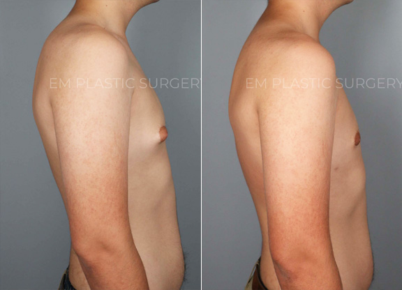 Gynecomastia Reduction Surgery Before & After