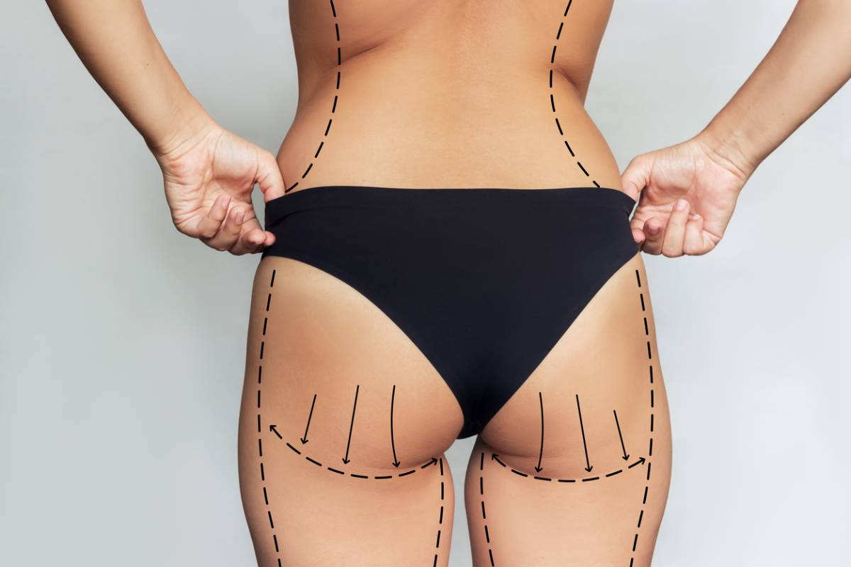 Featured image for How Long Does a Brazilian Butt Lift Last?