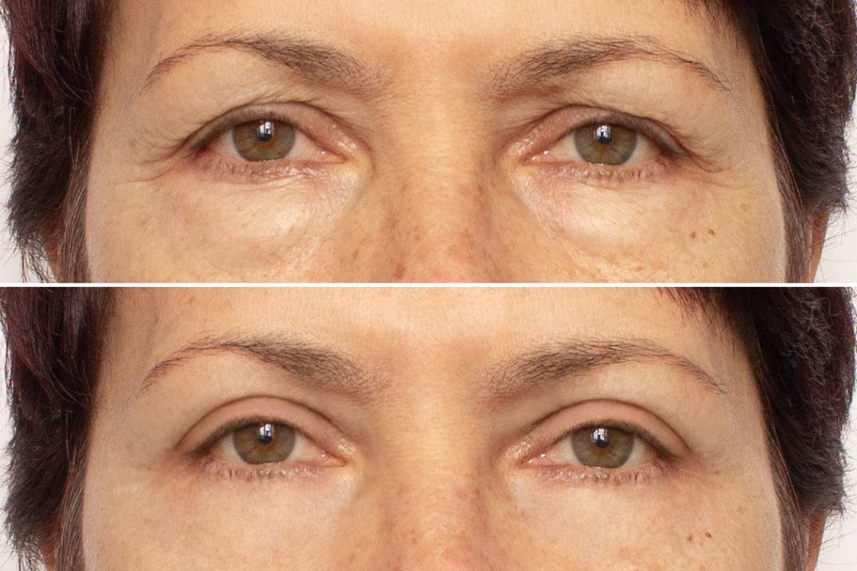 Featured image for How Long Does It Take to Recover from Eyelid Surgery
