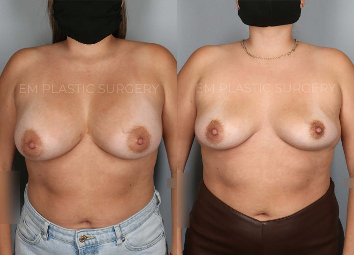 Breast Implant Removal Before & Afters