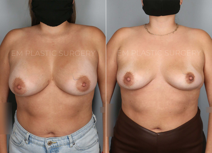 This is a 28 year-old patient who wanted her implants removed. She no longer cared for them
and felt that the implants were contributing to more back pain for her. The patient also wanted
to start trying to get pregnant so she wanted to get the surgery out of the way. She was initially
interested in a breast lift and fat transfer at the time of the removal but after my discussion
with her, she decided to see how she would bounce back with the implant removal alone. After
all, she had very youthful skin and tissue and had never undergone pregnancy and
breastfeeding so there was a good chance that her breasts would restore their shape without
additional procedures. She had 375cc breast implants removed in the operating room and her
breasts bounced back to looking natural and beautiful. She was so happy that she didn’t have to
undergo additional lift and fat transfer to achieve the outcome that she did.