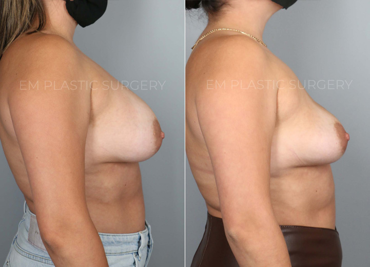 This is a 28 year-old patient who wanted her implants removed. She no longer cared for them
and felt that the implants were contributing to more back pain for her. The patient also wanted
to start trying to get pregnant so she wanted to get the surgery out of the way. She was initially
interested in a breast lift and fat transfer at the time of the removal but after my discussion
with her, she decided to see how she would bounce back with the implant removal alone. After
all, she had very youthful skin and tissue and had never undergone pregnancy and
breastfeeding so there was a good chance that her breasts would restore their shape without
additional procedures. She had 375cc breast implants removed in the operating room and her
breasts bounced back to looking natural and beautiful. She was so happy that she didn’t have to
undergo additional lift and fat transfer to achieve the outcome that she did.