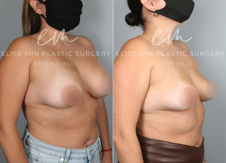 This is a 28 year-old patient who wanted her implants removed. She no longer cared for them and felt that the implants were contributing to more back pain for her. The patient also wanted to start trying to get pregnant so she wanted to get the surgery out of the way. She was initially interested in a breast lift and fat transfer at the time of the removal but after my discussion with her, she decided to see how she would bounce back with the implant removal alone. After all, she had very youthful skin and tissue and had never undergone pregnancy and breastfeeding so there was a good chance that her breasts would restore their shape without additional procedures. She had 375cc breast implants removed in the operating room and her breasts bounced back to looking natural and beautiful. She was so happy that she didn’t have to undergo additional lift and fat transfer to achieve the outcome that she did.