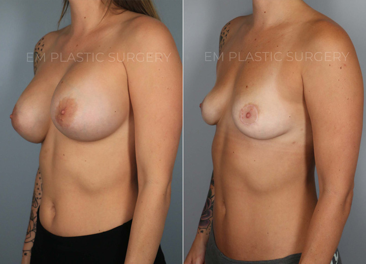 This is an active 30 year-old patient who had silicone breast implants placed ten years
prior to her presentation. She started to feel her implants getting tighter, which was
consistent with capsular contracture. Although she was hesitant about the size she
would be post-removal, she knew for sure that she did not want them anymore. She
underwent removal of 550cc silicone implants and thick capsules and concurrently
underwent a “donut” mastopexy to help restore symmetry to her nipple areolas. She
was baseline very fit which meant minimal donor sites to harvest fat from. However, in
thin patients, even small amounts of fat can be helpful. I was able to graft 60cc of fat
into each breast to help shape the breasts to make up for the stretched out appearance
the large implants had left her. She used to have AA cup-sized breasts prior to implants
and now she is a full A/small B cup size that she’s excited to have.