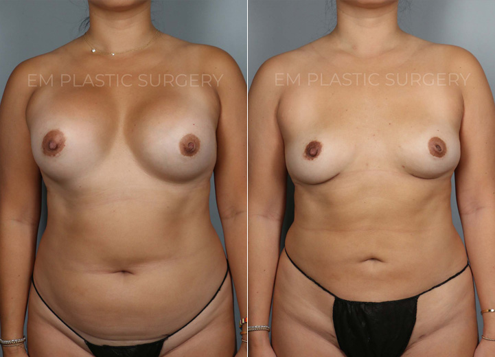 Breast Implant Removal Before & Afters