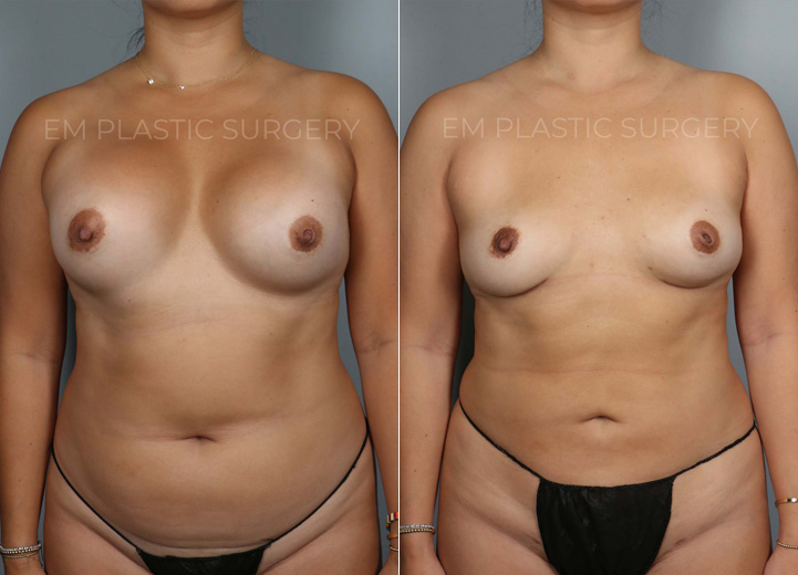 This 45 year-old patient had her implants placed two decades ago and developed
capsular contracture in the recent years. She felt tight in her right breast and it led to
more asymmetry of her breasts. She came into the office hoping to get rid of the
tightening effect of capsular contracture and restore breast symmetry. She also wanted
her natural breast shape back and did not want implants anymore. Mainly she did not
want more surgeries in the future. However, she was worried about how small she
would be after the implant removal. She also knew implants stretch out the overlying
tissue and leave a hollow appearance once the implants are removed. To help boost her
post-removal volume and shape, we discussed transferring fat to the breasts. She
underwent implant removal (300cc saline implants were removed) and capsulectomy to
remove the thick hardened capsule. She had 170cc of fat grafted into the right breast
and 100cc into the left breast to make up for the difference in the breast size. She was
excited to have symmetrical breasts again and love her natural breasts that feel lighter
and beautiful.