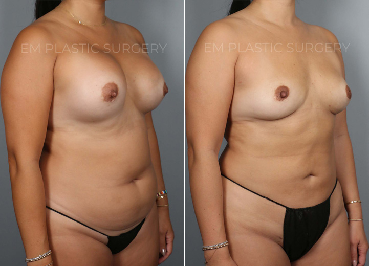 This 45 year-old patient had her implants placed two decades ago and developed
capsular contracture in the recent years. She felt tight in her right breast and it led to
more asymmetry of her breasts. She came into the office hoping to get rid of the
tightening effect of capsular contracture and restore breast symmetry. She also wanted
her natural breast shape back and did not want implants anymore. Mainly she did not
want more surgeries in the future. However, she was worried about how small she
would be after the implant removal. She also knew implants stretch out the overlying
tissue and leave a hollow appearance once the implants are removed. To help boost her
post-removal volume and shape, we discussed transferring fat to the breasts. She
underwent implant removal (300cc saline implants were removed) and capsulectomy to
remove the thick hardened capsule. She had 170cc of fat grafted into the right breast
and 100cc into the left breast to make up for the difference in the breast size. She was
excited to have symmetrical breasts again and love her natural breasts that feel lighter
and beautiful.