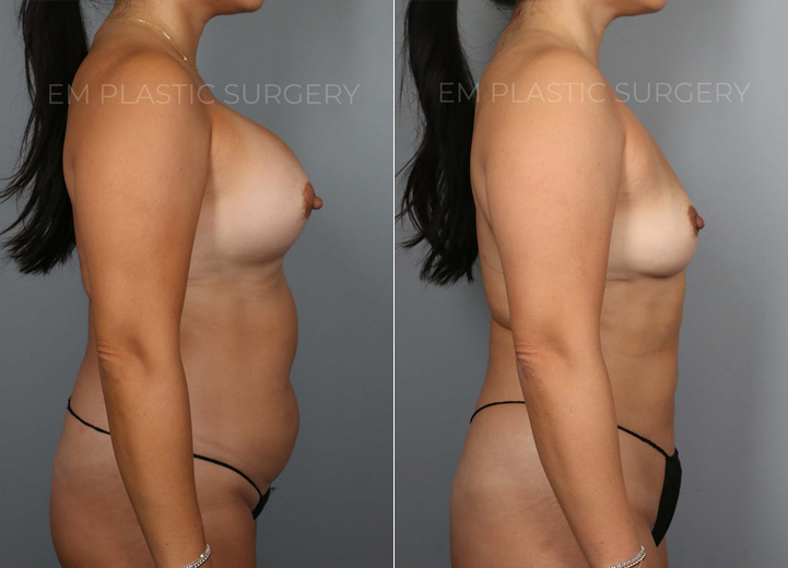 This 45 year-old patient had her implants placed two decades ago and developed
capsular contracture in the recent years. She felt tight in her right breast and it led to
more asymmetry of her breasts. She came into the office hoping to get rid of the
tightening effect of capsular contracture and restore breast symmetry. She also wanted
her natural breast shape back and did not want implants anymore. Mainly she did not
want more surgeries in the future. However, she was worried about how small she
would be after the implant removal. She also knew implants stretch out the overlying
tissue and leave a hollow appearance once the implants are removed. To help boost her
post-removal volume and shape, we discussed transferring fat to the breasts. She
underwent implant removal (300cc saline implants were removed) and capsulectomy to
remove the thick hardened capsule. She had 170cc of fat grafted into the right breast
and 100cc into the left breast to make up for the difference in the breast size. She was
excited to have symmetrical breasts again and love her natural breasts that feel lighter
and beautiful.