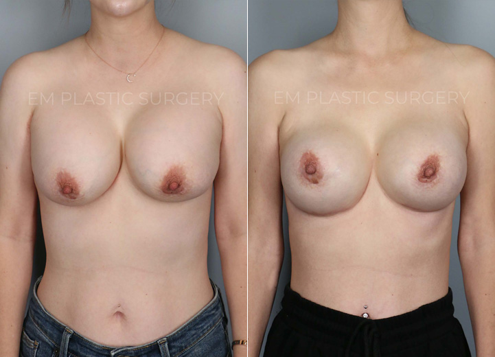 This 40-year-old mother of two initially had several breast revision surgeries by her prior plastic surgeon for recurrent capsular contracture. Unfortunately the capsular contracture returned and progressed to the point that it was visible and uncomfortable. She wanted her soft breasts back with a more natural breast shape but did not want any additional scars that would be a part of a breast lift procedure. During the operation, her Sientra 415 high profile silicone breast implants were taken out, and in their place, Sientra 445 extra-high profile silicone breast implants were put in. To address her capsular contracture, she had her thickened capsule completely removed and had acellular dermal matrix (ADM) mesh placed as an inferior sling. The ADM mesh can be useful in reducing the risk of future capsular contracture, especially in recurrent capsular contracture situation.