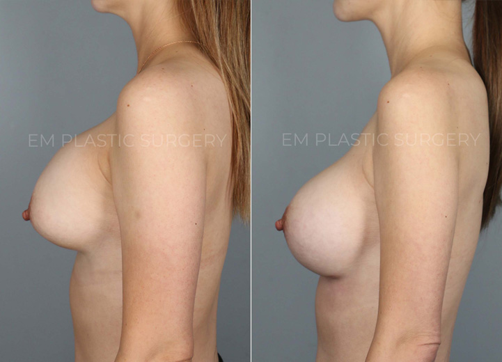 This 40-year-old mother of two initially had several breast revision surgeries by her prior plastic surgeon for recurrent capsular contracture. Unfortunately the capsular contracture returned and progressed to the point that it was visible and uncomfortable. She wanted her soft breasts back with a more natural breast shape but did not want any additional scars that would be a part of a breast lift procedure. During the operation, her Sientra 415 high profile silicone breast implants were taken out, and in their place, Sientra 445 extra-high profile silicone breast implants were put in. To address her capsular contracture, she had her thickened capsule completely removed and had acellular dermal matrix (ADM) mesh placed as an inferior sling. The ADM mesh can be useful in reducing the risk of future capsular contracture, especially in recurrent capsular contracture situation.