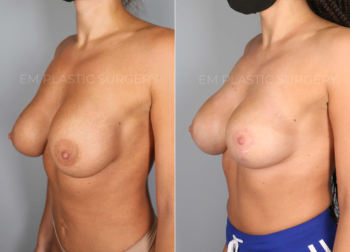 This charming 29-year-old patient had Sientra 350cc silicone breast implants placed by her prior plastic surgeon. During the first few months, she developed severe left-sided capsular contracture along with severe animation deformity (displacement of breast implants when the patient flexes her chest muscles). She desired correction of all her problems along with a larger breast size and a breast lift. During the procedure, her thick capsule was removed, and her breast implants were changed from being under the pectoralis chest muscle to over the muscle, thereby fixing her breast implant problems. Her new implant size was Sientra moderate plus 435, and with a concurrent lollipop breast lift, she was thrilled to achieve larger, perkier, and more symmetrical breasts that she had wanted from the beginning of her breast augmentation journey.