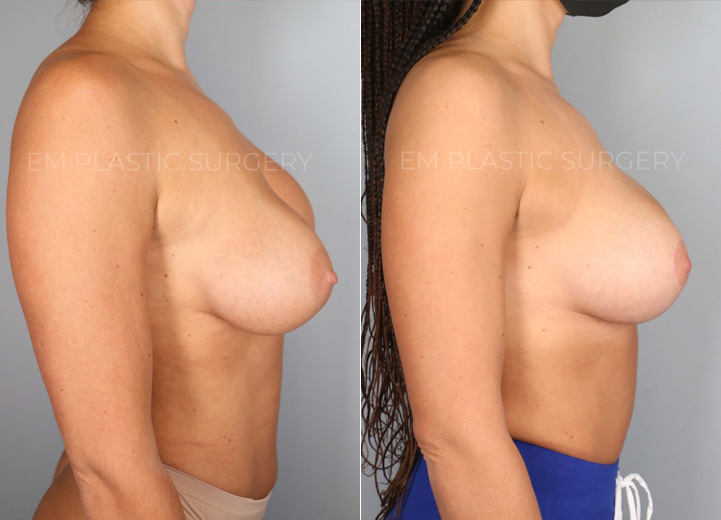 This charming 29-year-old patient had Sientra 350cc silicone breast implants placed by her prior plastic surgeon. During the first few months, she developed severe left-sided capsular contracture along with severe animation deformity (displacement of breast implants when the patient flexes her chest muscles). She desired correction of all her problems along with a larger breast size and a breast lift. During the procedure, her thick capsule was removed, and her breast implants were changed from being under the pectoralis chest muscle to over the muscle, thereby fixing her breast implant problems. Her new implant size was Sientra moderate plus 435, and with a concurrent lollipop breast lift, she was thrilled to achieve larger, perkier, and more symmetrical breasts that she had wanted from the beginning of her breast augmentation journey.