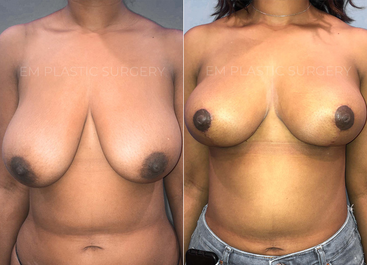 This is a woman in her 20s who underwent a 25 pound weight loss that resulted in saggy,
deflated breasts. She was fitting into a DD cup-sized bra and wanted to maintain her volume
but wanted perkier breasts. She initially inquired about a breast implant to achieve this and I
explained that she has adequate breast tissue to help achieve what she wants without
implants. She was thrilled to hear this and underwent a vertical ("lollipop”) breast lift and felt
stellar after the procedure.