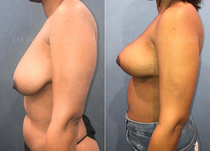 This is a woman in her 20s who underwent a 25 pound weight loss that resulted in saggy,
deflated breasts. She was fitting into a DD cup-sized bra and wanted to maintain her volume
but wanted perkier breasts. She initially inquired about a breast implant to achieve this and I
explained that she has adequate breast tissue to help achieve what she wants without
implants. She was thrilled to hear this and underwent a vertical ("lollipop”) breast lift and felt
stellar after the procedure.