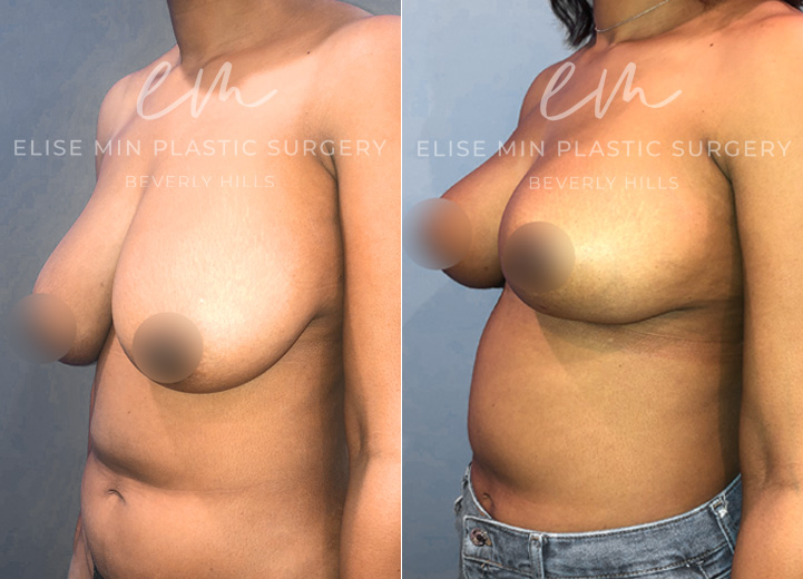 This is a woman in her 20s who underwent a 25 pound weight loss that resulted in saggy, deflated breasts. She was fitting into a DD cup-sized bra and wanted to maintain her volume but wanted perkier breasts. She initially inquired about a breast implant to achieve this and I explained that she has adequate breast tissue to help achieve what she wants without implants. She was thrilled to hear this and underwent a vertical (