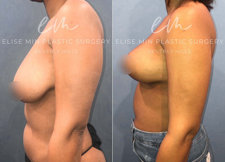 This is a woman in her 20s who underwent a 25 pound weight loss that resulted in saggy, deflated breasts. She was fitting into a DD cup-sized bra and wanted to maintain her volume but wanted perkier breasts. She initially inquired about a breast implant to achieve this and I explained that she has adequate breast tissue to help achieve what she wants without implants. She was thrilled to hear this and underwent a vertical (