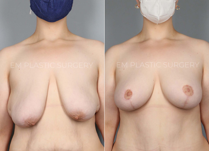 This remarkable 24-year-old patient lost 150 pounds over two years through a healthy diet and exercise. The successful weight loss led to excess skin that did not shrink back as she desired. She now desired perkier, fuller breasts but was not interested in having breast implants placed. Based on her anatomy and desires, a custom-tailored plan was made for her, and she underwent a breast lift using the auto-augmentation mastopexy technique. This method allowed the excess skin and tissue along the side of her chest below her armpit area to be rotated into her breast tissue to give extra perk and volume. This is a great technique, particularly for massive weight loss patients who frequently have excess skin and tissue to the side of their breasts. In one area, it may be undesirable, saggy tissue, but in another, it can be the key to extra perky volume!