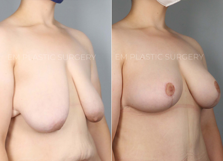 This remarkable 24-year-old patient lost 150 pounds over two years through a healthy diet and exercise. The successful weight loss led to excess skin that did not shrink back as she desired. She now desired perkier, fuller breasts but was not interested in having breast implants placed. Based on her anatomy and desires, a custom-tailored plan was made for her, and she underwent a breast lift using the auto-augmentation mastopexy technique. This method allowed the excess skin and tissue along the side of her chest below her armpit area to be rotated into her breast tissue to give extra perk and volume. This is a great technique, particularly for massive weight loss patients who frequently have excess skin and tissue to the side of their breasts. In one area, it may be undesirable, saggy tissue, but in another, it can be the key to extra perky volume!