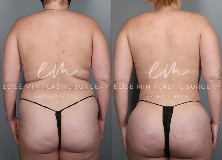 This is a 35-year-old woman who had long been desiring a natural, slimmer torso. She was at a stable weight and decided to take the plunge towards a slimmer waistline. She underwent a 3-dimensional body liposuction and gentle fat transfer to the hip dips on both sides to regain confidence. 