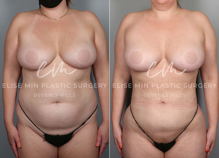 This is a 35-year-old woman who had long been desiring a natural, slimmer torso. She was at a stable weight and decided to take the plunge towards a slimmer waistline. She underwent a 3-dimensional body liposuction and gentle fat transfer to the hip dips on both sides to regain confidence. 