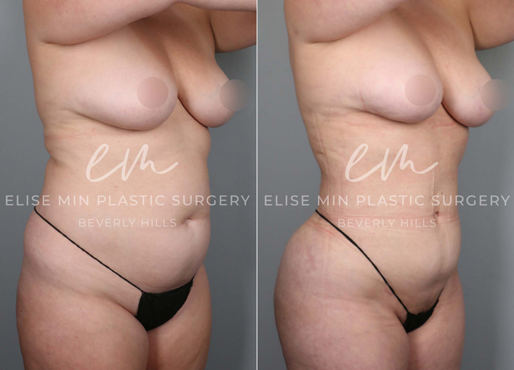 This is a 35-year-old woman who had long been desiring a natural, slimmer torso. She was at a stable weight and decided to take the plunge towards a slimmer waistline. She underwent a 3-dimensional body liposuction and gentle fat transfer to the hip dips on both sides to regain confidence. 