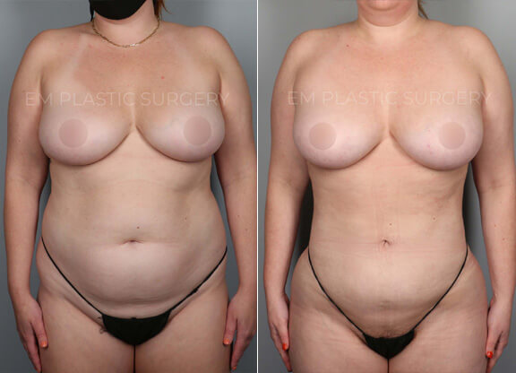 Liposuction Surgery Before & After